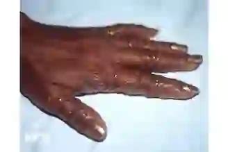 dyshidrotic eczema on black skin|dyshidrotic eczema patient handout.